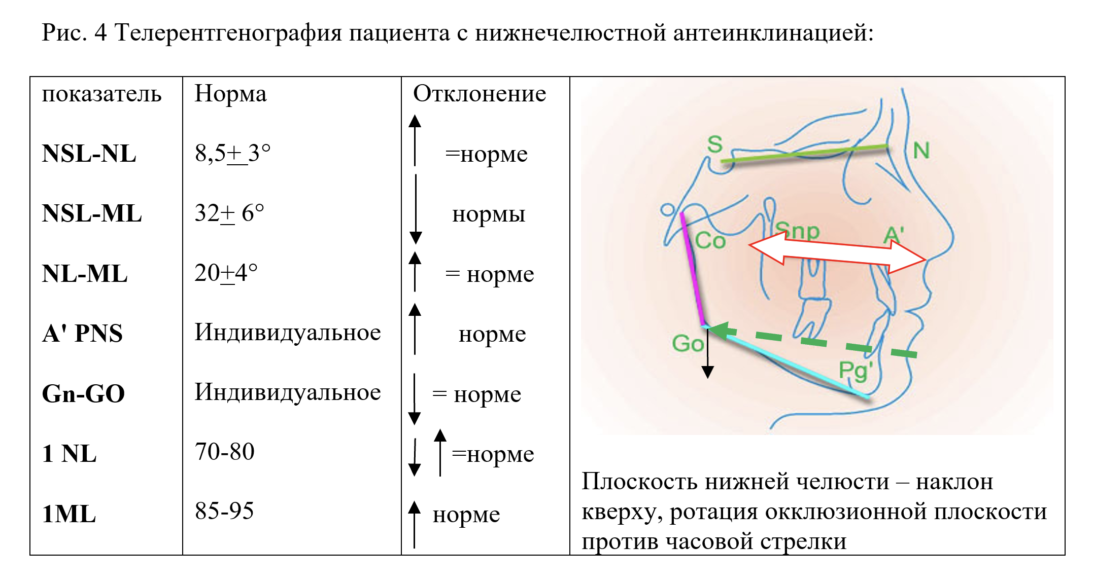 ТРГ пациента с НЧ антеинклинацией